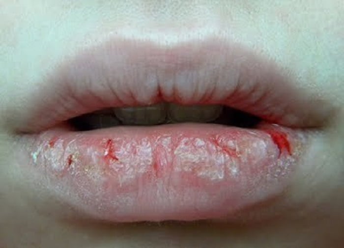  Veja cinco doenças que podem ser identificadas apenas pelo comportamento da boca