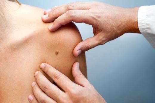  Estudo diz que uso de diuréticos pode aumentar risco de câncer de pele
